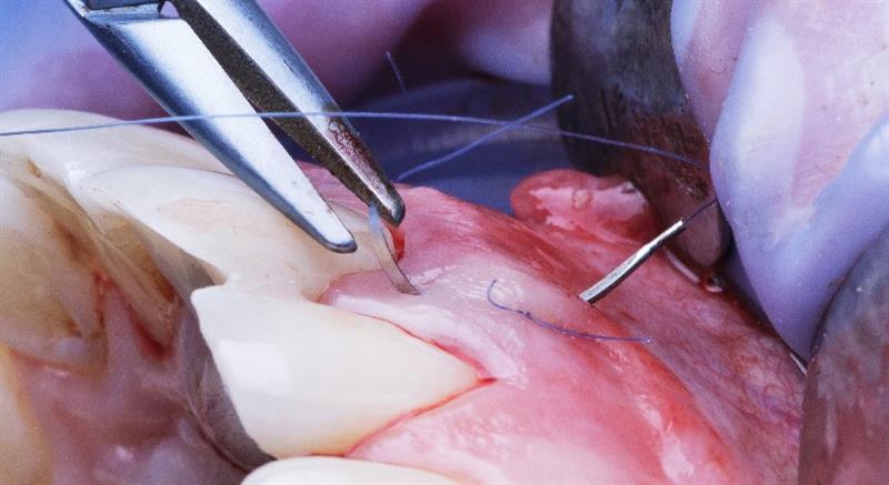 Suturing in General Dentistry: Principles, Practice & Precision