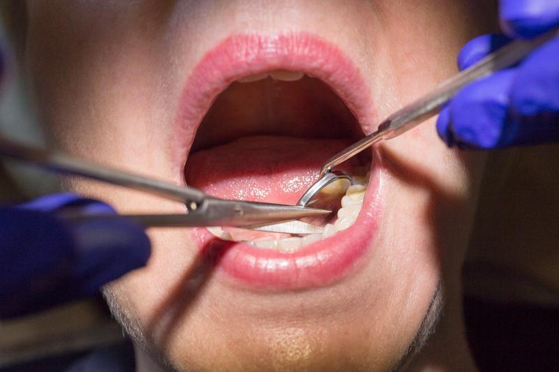 Suture removal and post-operative care for clinical dental technicians