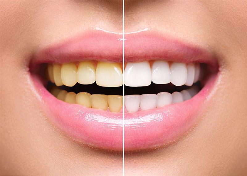 One Day Tooth Whitening Course – incorporating impression taking