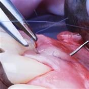 Suturing in General Dentistry: Principles, Practice & Precision