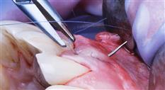 Suturing in General Dentistry: Principles, Practice & Precision