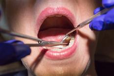 Suture Removal and post-operative Care for Nurses and Hygienists