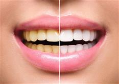 One Day Tooth Whitening Course – Incorporating Impression Taking
