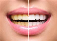 One Day Tooth Whitening Course – incorporating impression taking