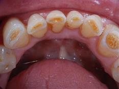 Tooth Wear - Aetiology and Management